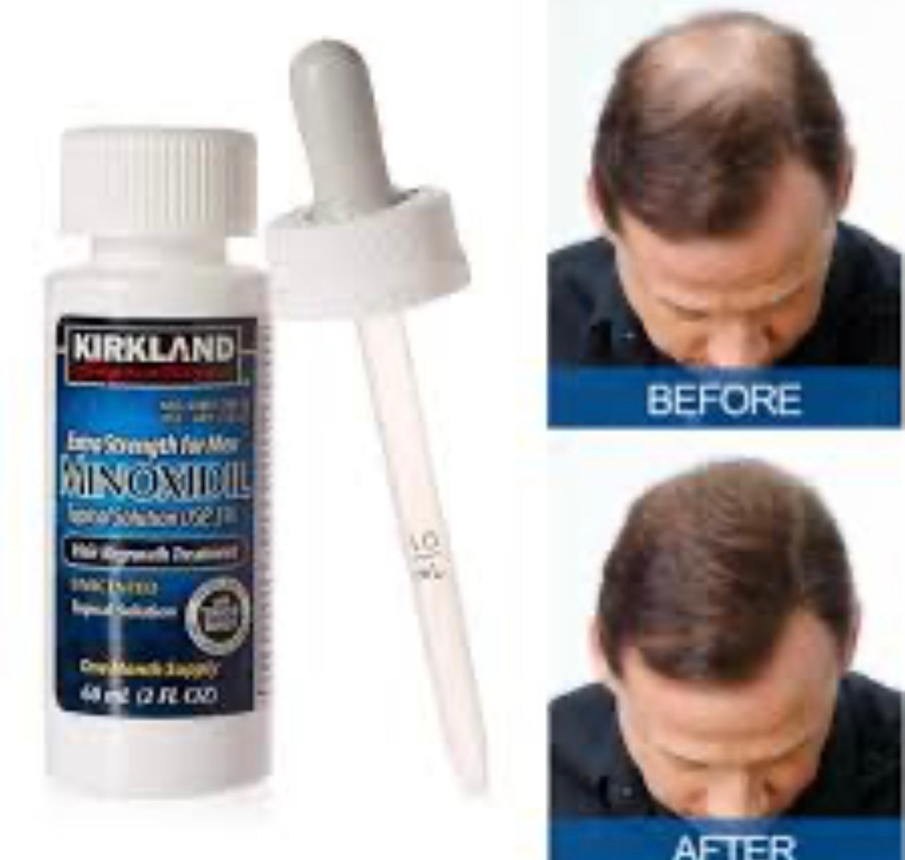 Minoxidil pour Barbe et Cheuveux